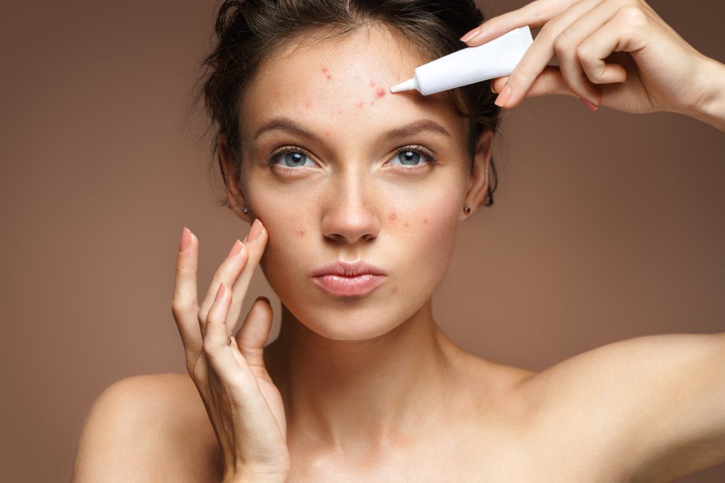 huidproblemen acne